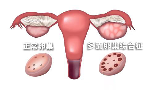 多囊卵巢综合征，阻碍了你当妈妈的步伐，该如何应对?