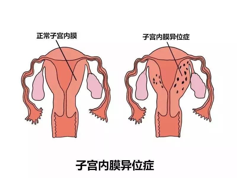 子宫内膜异位症与正常子宫内膜对比