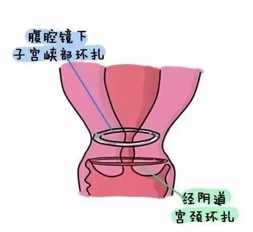 腹腔镜下子宫峡部环扎,宫腔镜下经阴道宫颈环扎