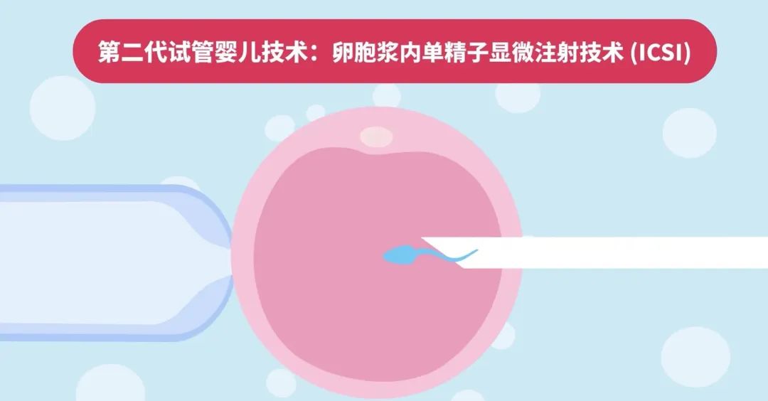 第二代试管婴儿技术: 卵胞浆内单精子显微注射技术(CSI)