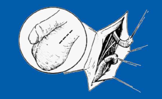 而男性的整个睾丸都是具有生精能力的,因穿刺活检仅仅是检查的一个