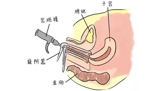 妇科微创手术辅助