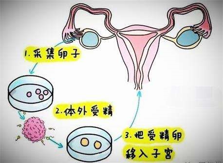 试管婴儿示意图