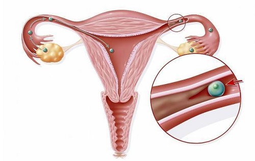 为什么做试管，还要检查输卵管？