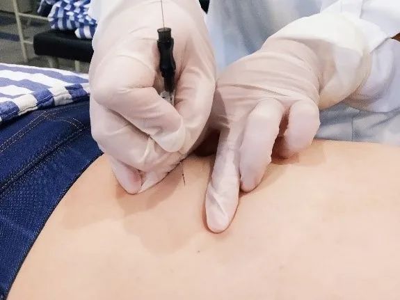 都是第一次做针灸埋线，为啥别人效果就更棒？