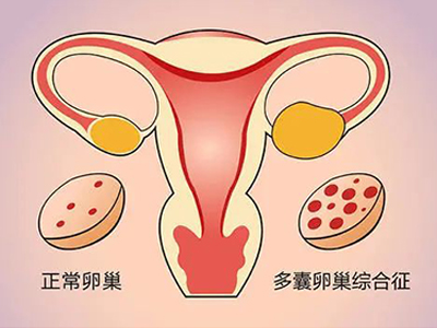 多毛又肥胖，小心是多囊在“搞鬼”！