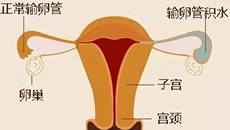 输卵管积液必须手术吗