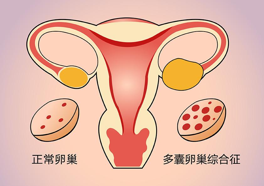 原来月经紊乱、肥胖、甚至不孕是因为多囊卵巢综合征？？