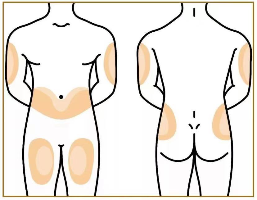 克赛肝素注射部位图图片