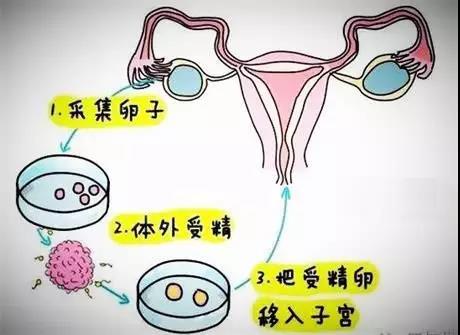 怎样做试管婴儿？试管婴儿示意图