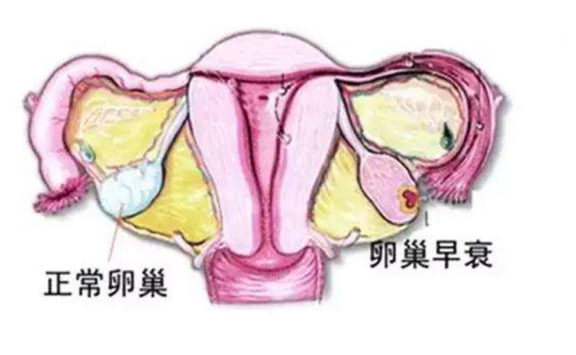 下常卵巢与早衰卵巢对比