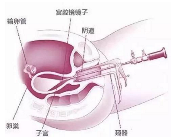 宫腔镜检查更加直观