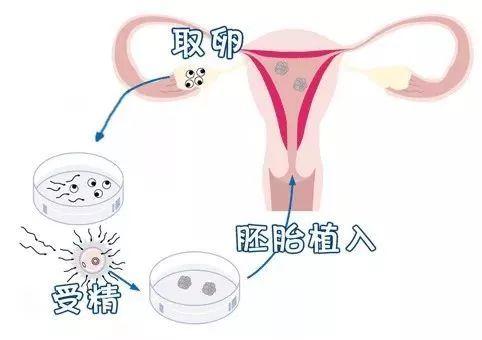 第一代试管婴儿技术