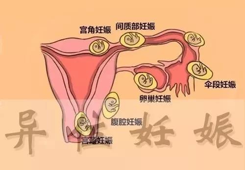 宫角妊娠位置图片