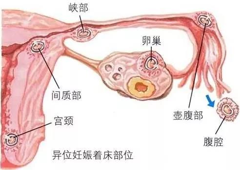 异们妊娠