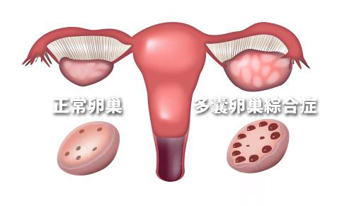 多囊卵巢综合征表现形式