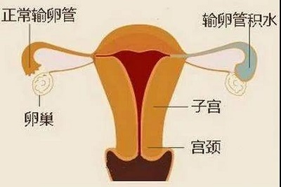 输卵管积水示意图