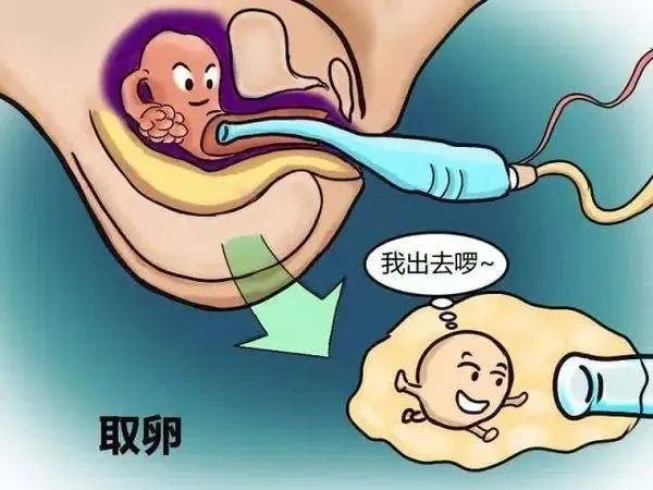 试管婴儿：取卵