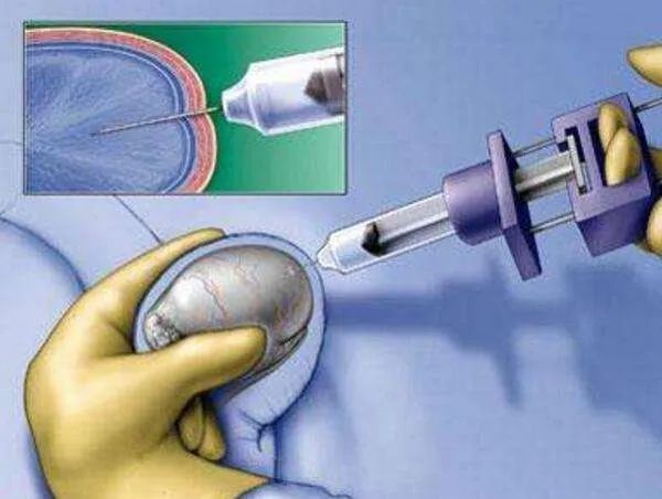 睾丸穿刺取经术，穿刺的是睾丸一个点
