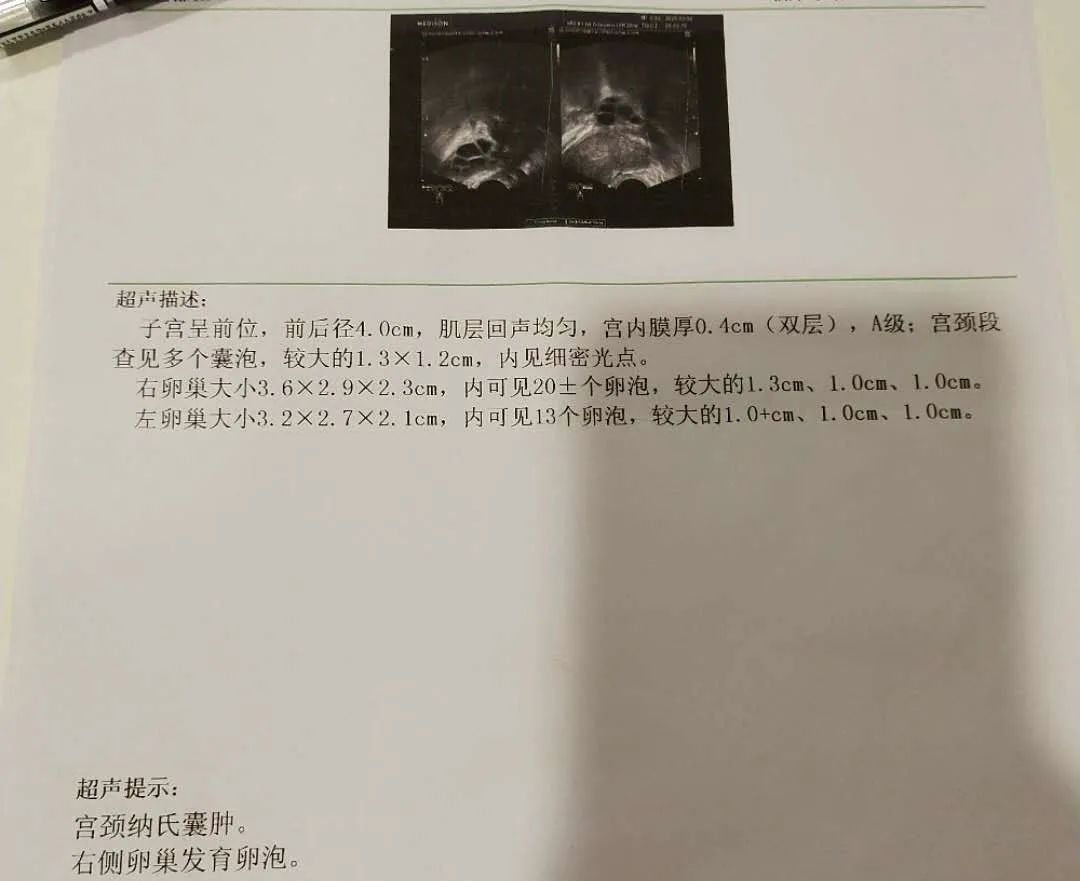 多囊卵巢综合征备孕：给予多次促排卵药物注射后，卵泡依旧生长缓慢图1