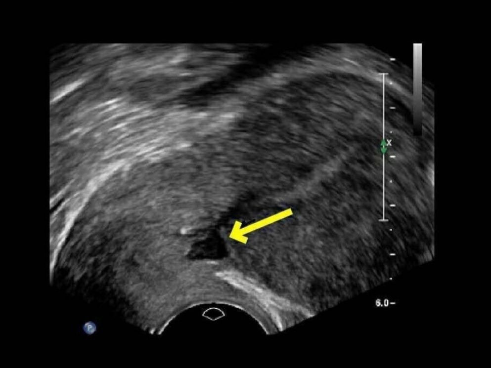 B超下的瘢痕憩室
