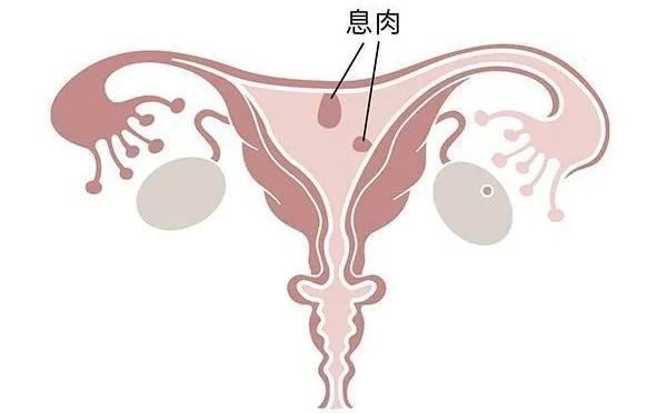 息肉就是子宫内膜上长出的一些肉坨坨