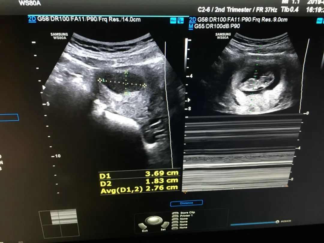 怀孕四周，彩超检查宫腔内偏右侧宫角可见7*7囊样无回声 - 百度宝宝知道