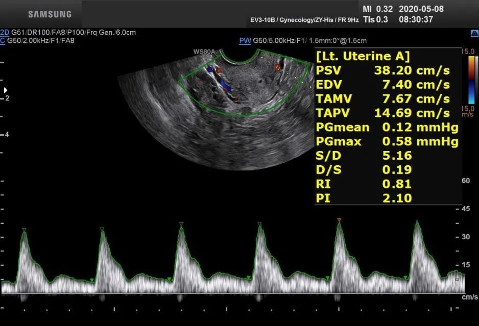 子宫动脉的测量，直接或间接反映出子宫肌层到内膜的供血情况