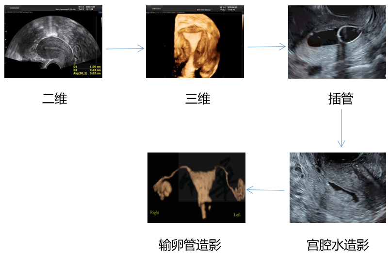 “一站式”宫腔输卵管造影体系检查步骤