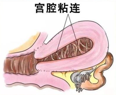 宫腔粘连