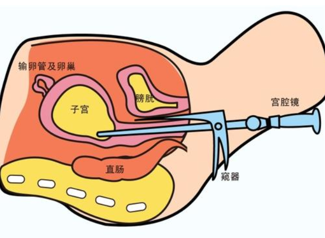 什么是宫腔镜