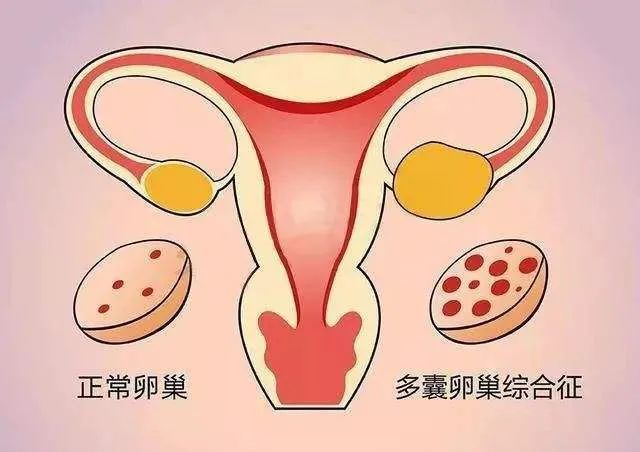 正常卵巢VS多囊卵巢综合征