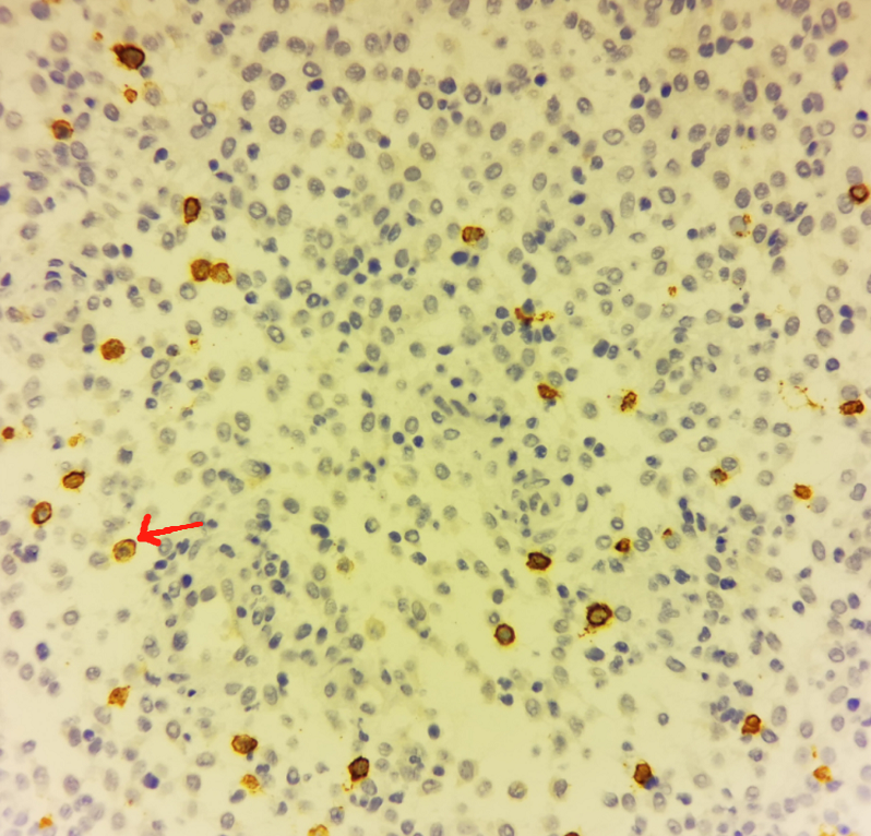 CD138、CD38免疫组化阳性