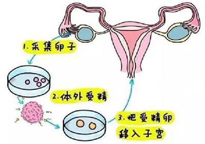 采集卵子、体外受精、把受精卵移入子宫