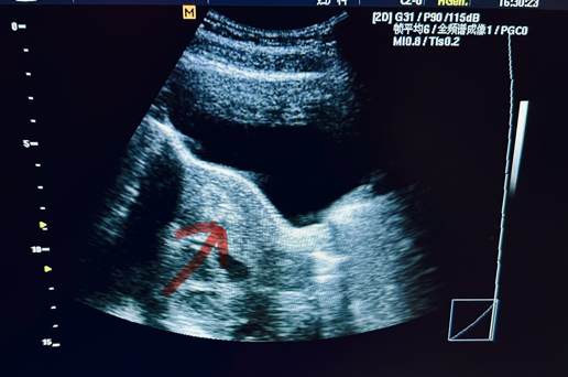 从B超上可看见一个“小白点”，这就是您的胚胎宝宝呆的位置