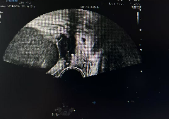 术前术后彩超对比图