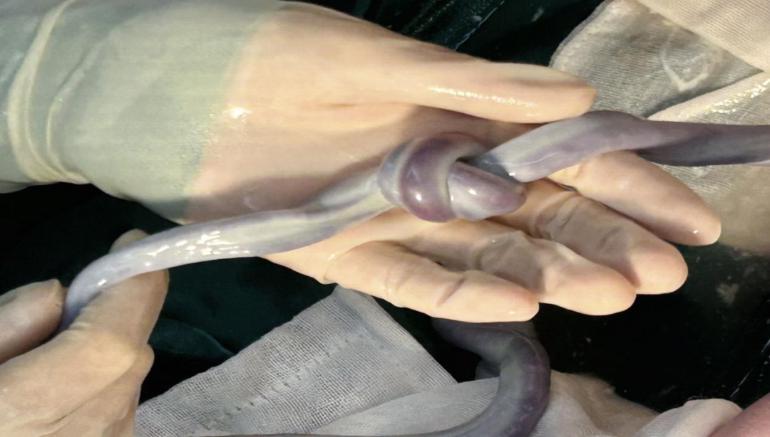 当宝宝娩出时发现,原本B超显示的脐带绕颈两圈,实际上却是绕颈三圈,而且更令人惊讶的是,还存在脐带真结。