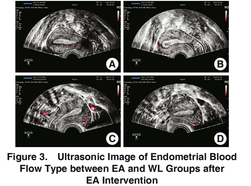 电针对复发性植入失败患者子宫内膜血流的直接刺激效果的一项随机对照试验