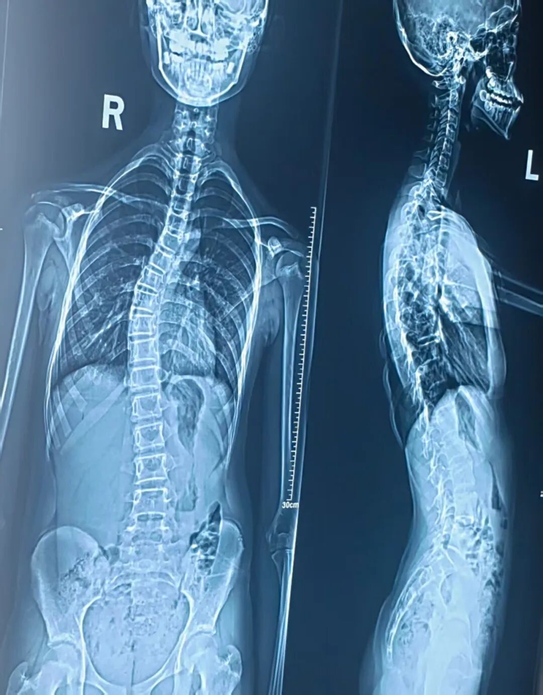 脊柱侧弯属于重度，需进行手术治疗，术后配合形体治疗和中医传统手法促进恢复。