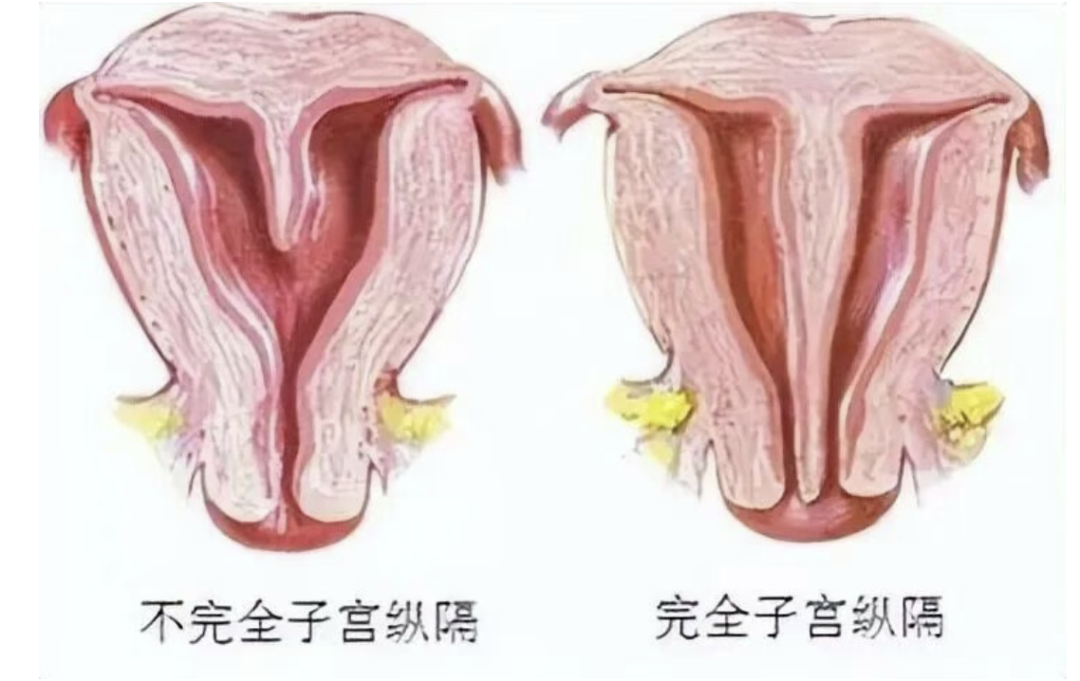 不孕合并子宫纵隔，到底要不要做手术？会不会流产？